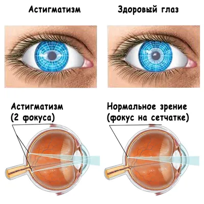 Как связаны между собой катаракта и астигматизм? - Центр Хирургии Глаза