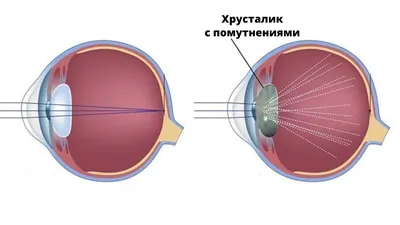 Врожденная катаракта | МНТК
