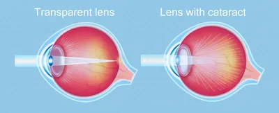 Катаракта и структура здорового глаза подробная Иллюстрация вектора -  иллюстрации насчитывающей зрачок, медицинско: 210819597