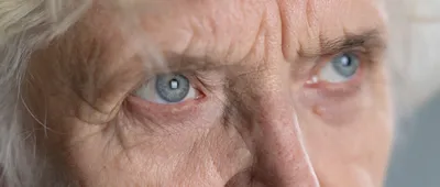 Ядерная катаракта — что это, причины, симптомы и лечение | GlazCo