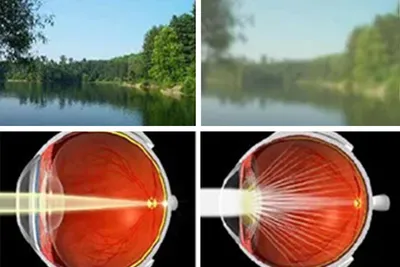 Операция по удалению катаракты в Москве по цене от 44000 ₽ - стоимость  замены хрусталика глаза