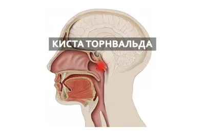 Операция по удалению кисты Торнвальда - «Лазерная деструкция кисты  Торнвальда или как меня дважды поджарили живьём😁» | отзывы