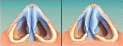 Искривление перегородки носа