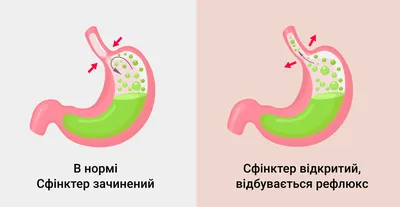 ᐈ Симптомы эзофагита ~【Лечение в Киеве】