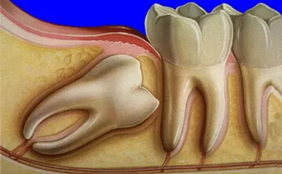 Болит зуб мудрости: как снять боль, что делать