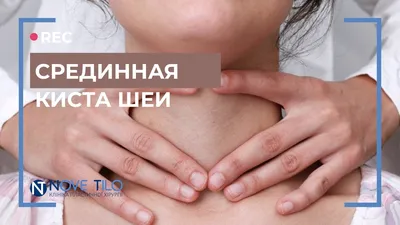 Кисты шеи: цена, диагностика и хирургическое лечение в клинике Nove Tilo -  Nove Tilo