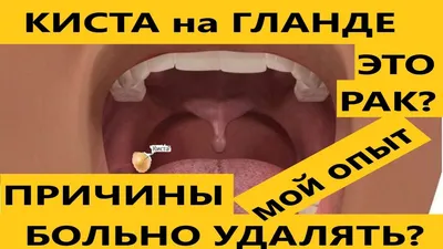 Киста на миндалине, причины, последствия, как удаляли? - YouTube