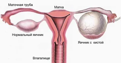 ▶️ Киста яичника симптомы и лечение в Москве — клиника Девита