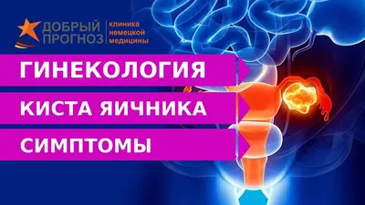 ≡ Киста яичника ▷ Лечение в Киеве — Клиника «Добрый прогноз»