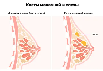 Воспаление грудных желез у кормящей мамы