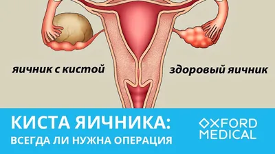 Киста желтого тела яичника - симптомы и лечение в Москве - Здоровая Семья