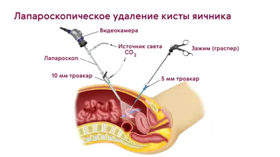 Киста яичника: симптомы у женщин и девушек, признаки кисты, причины  появления, лечение