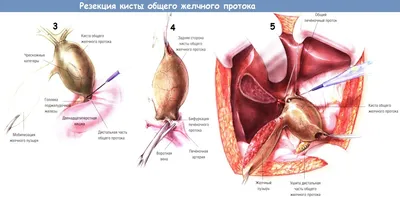 Доступ и ход операции резекции кисты общего желчного протока