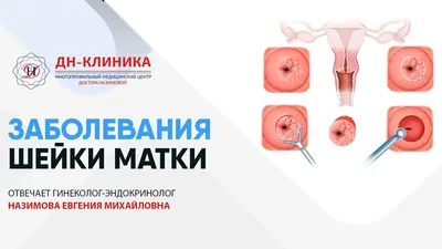 Киста женских органов фото