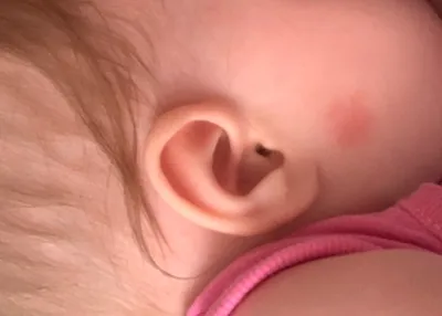 Сыпь у новорожденного на лице и шее - YouTube