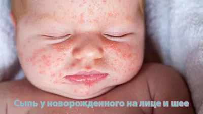 Сыпь у ребенка без температуры: почему появляется и что при этом делать