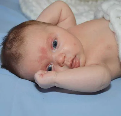 Красное пятно на лбу у новорожденного фото