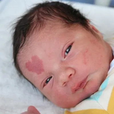 Акне новорожденных и все, что необходимо знать об этом — Allergika  (Аллергика) Украина