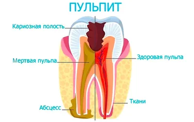 Воспаление лимфоузлов из-за кариеса: как связаны два заболевания -  энциклопедия Ochkov.net