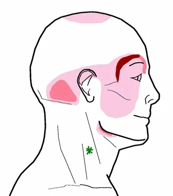 Головная боль за ушами | Клинический Институт Мозга | Дзен