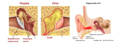 Наружный отит - причины, симптомы, диагностика и лечение