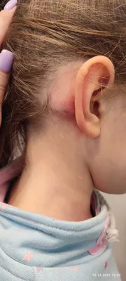 Ушиб за ухом шишка - Вопрос детскому хирургу - 03 Онлайн