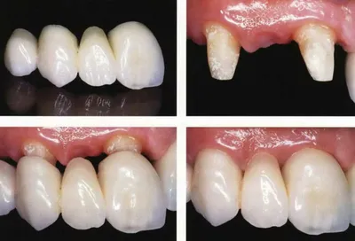 Установить металлокерамические коронки в Москве - цены в стоматологии  РуДента