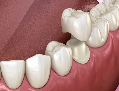 Металлокерамические коронки на зубы: виды, особенности, цены, стоимость  установки металлокерамической коронки на зуб
