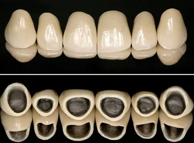Разница между коронками из металлокерамики и циркония - что лучше, что  дешевле?