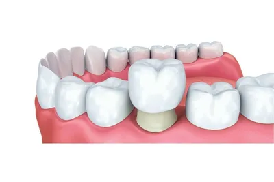 Металлокерамическая коронка с плечевой массой вокруг шейки зуба