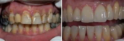 Металлокерамика на передние зубы | Виды, преимущества, недостатки | Клиника  семейной стоматологии Дока-Дент
