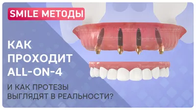 Металлокерамическая коронка на зубы отзывы, фото, стоимость, плюсы минусы,  срок службы коронок.