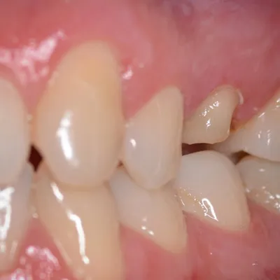 Коронка на зуб в Рязани по выгодным ценам - Клиника \"Альфа-стоматология\"