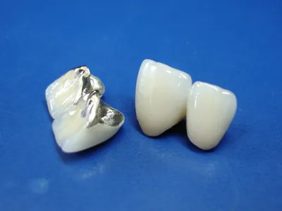 Металлокерамические коронки на передние зубы в Санкт-Петербурге