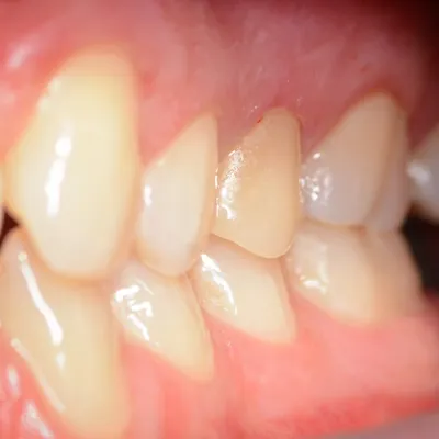 Коронка на зуб в Рязани по выгодным ценам - Клиника \"Альфа-стоматология\"