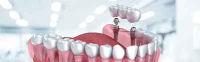 Коронка на зуб | цены на зубные коронки в Армавире в стоматологии