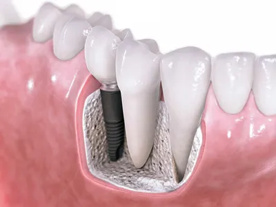 Металлокерамические коронки на зубы — цены под ключ на установку|«Астродент»