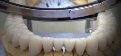 Металлокерамика - установка металлокерамических коронок в сети клиник  ЗубОК, лечение зубов