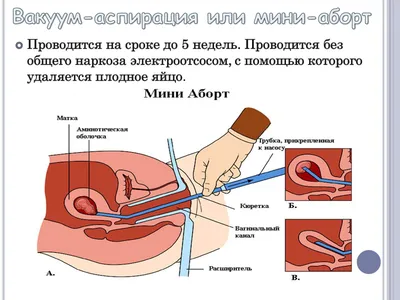 Презентація на тему Аборт — презентації з біології | GDZ4YOU