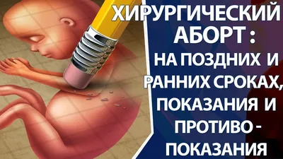 Мини аборт в день обращения по цене от 4500 рублей: где сделать платно мини  аборт в Москве, сроки проведения мини аборта в клинике