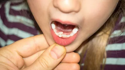 Акульи зубки у детей: что делать, если зубы растут в два ряда - Летидор