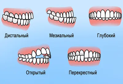 Аномалии роста зубов - Вита 3D