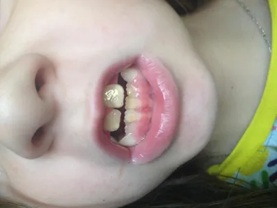 У ребёнка коренные зубы растут желтые - Детская стоматология - Форум  стоматологов (стомотологический форум) - Профессиональный стоматологический  портал (сайт) «Клуб стоматологов»