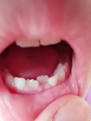 Нужно ли удалять соседние молочные зубы, чтобы коренные ровно встали? |  Детская и семейная стоматологическая клиника \"Белая Медведица\" |  Санкт-Петербург