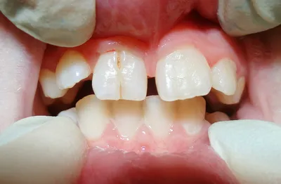 Особенности строения и прорезывания передних и жевательных молочных зубов у  детей: схемы и фото, из чего состоит корень, смена зубного ряда у человека  – Dentika