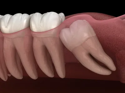 Ретенция зубов: причины и симптомы, методы диагностики, лечения и  профилактики - SHiFA
