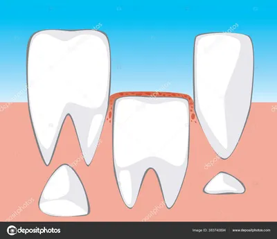 Постоянный Зуб Растет Десен Концепция Изменения Молочных Зубов Детей  Плоский векторное изображение ©Miroshnikova_Viktoriia 383740894