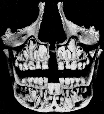 Как выглядит череп ребенка до выпадения молочных зубов | Пикабу