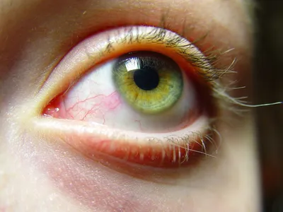 Желтое пятно на белке глаза - 49 фото