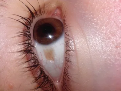 Злокачественные новообразования глаз: лечение, прогноз